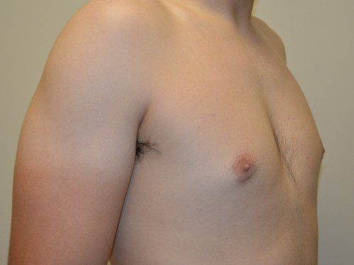 Male Breast Reduction After Patient 2