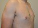 Male Breast Reduction After Patient Thumbnail 2