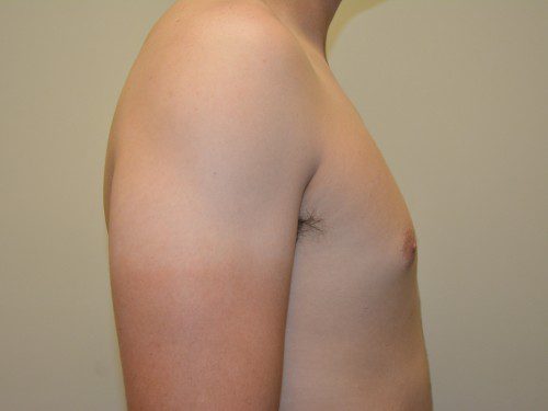 Male Breast Reduction After Patient 3