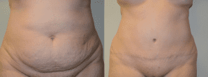Before and After Tummy Tuck Surgery