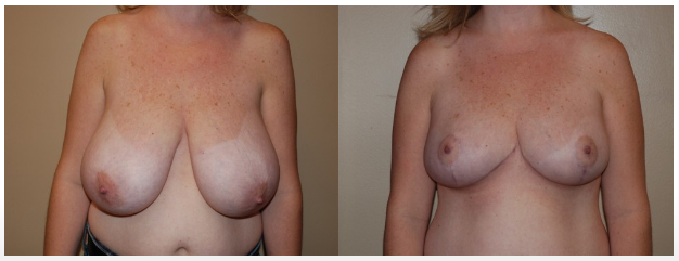 Breast Reduction Before and After Photos