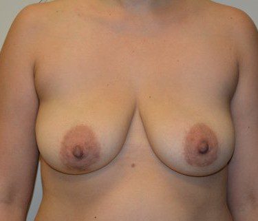 Breast Implant Removal After Patient 1