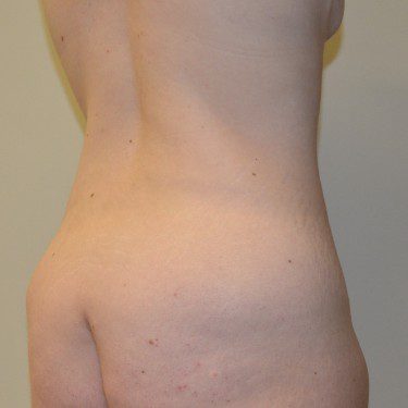 Body Lift Before Patient 6