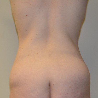 Body Lift Before Patient 8