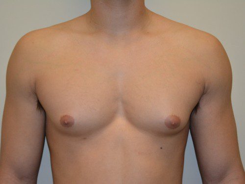 Male Breast Reduction Before Patient 1