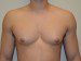 Male Breast Reduction Before Patient Thumbnail 1