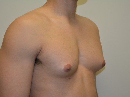 Male Breast Reduction Before Patient 2