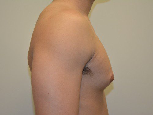 Male Breast Reduction Before Patient 3