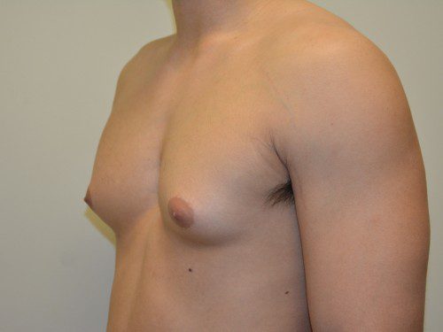 Male Breast Reduction Before Patient 4