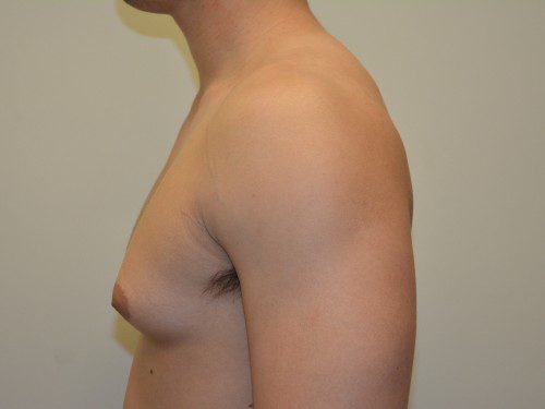 Male Breast Reduction Before Patient 5