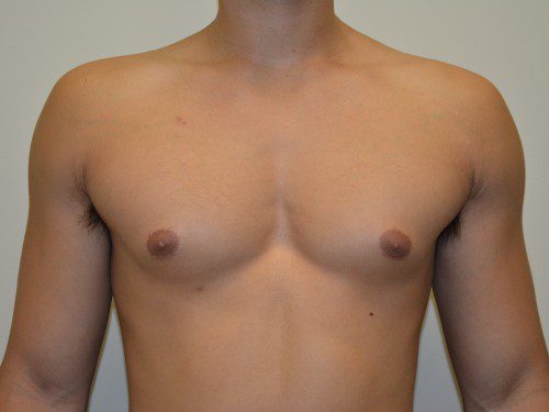 Male Breast Reduction After Patient 1