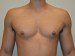 Male Breast Reduction After Patient Thumbnail 1