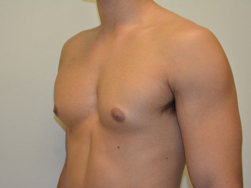Male Breast Reduction After Patient 4
