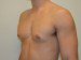 Male Breast Reduction After Patient Thumbnail 4