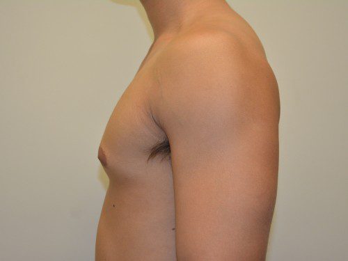 Male Breast Reduction After Patient 5