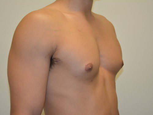 Male Breast Reduction After Patient 2