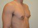 Male Breast Reduction After Patient Thumbnail 2