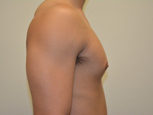 Male Breast Reduction After Patient 3