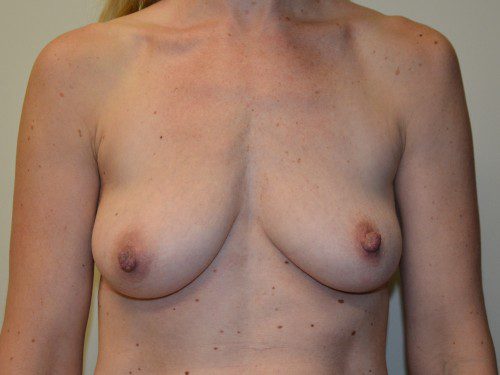 Breast Augmentation w/Lift Before Patient 1