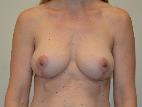 Breast Augmentation w/Lift After Patient 1