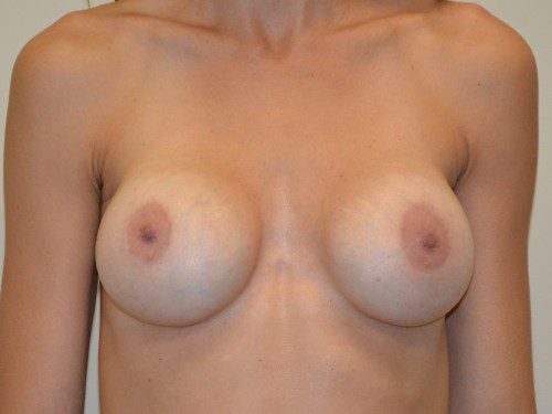 Breast Revision Before Patient 1