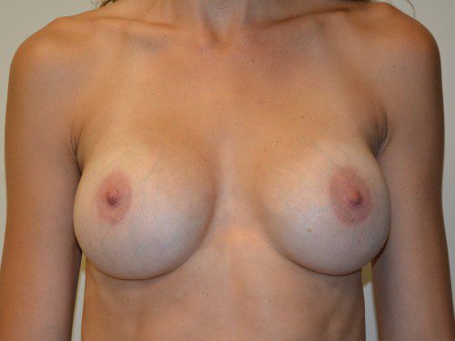 Breast Revision After Patient 1