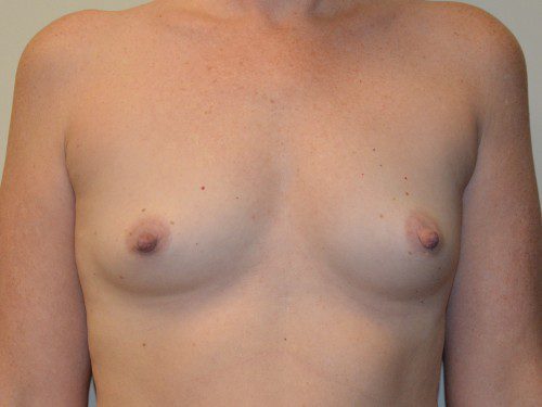 Breast Augmentation Before Patient 1