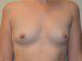 Breast Augmentation Before Patient Thumbnail 1