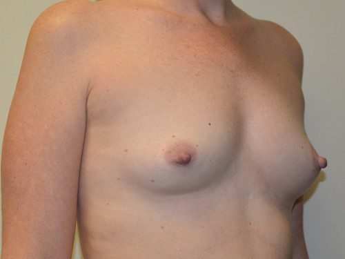 Breast Augmentation Before Patient 4