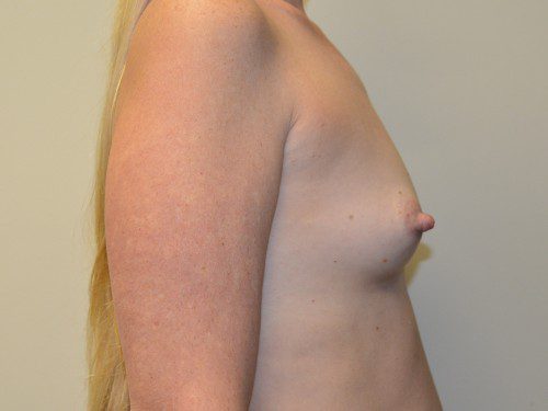 Breast Augmentation Before Patient 5