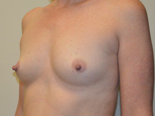 Breast Augmentation Before Patient 2