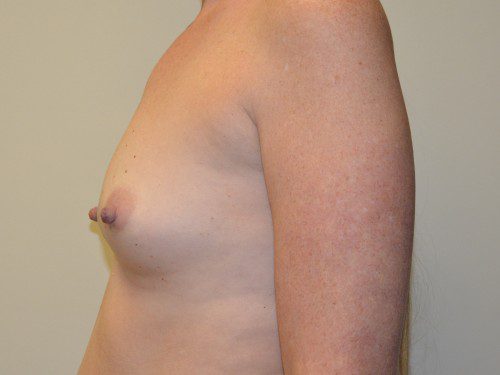 Breast Augmentation Before Patient 3