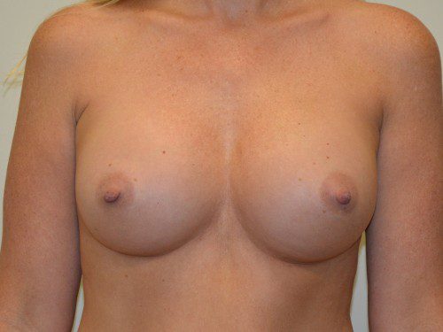 Breast Augmentation After Patient 1