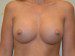 Breast Augmentation After Patient Thumbnail 1