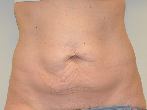 Tummy Tuck Before Patient 1