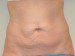 Tummy Tuck Before Patient Thumbnail 1