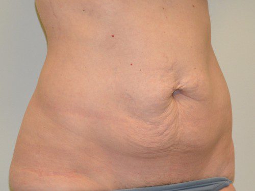 Tummy Tuck Before Patient 4