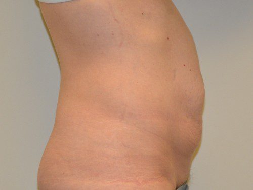 Tummy Tuck Before Patient 5