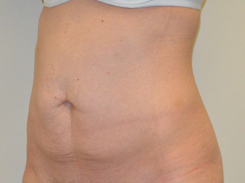 Tummy Tuck Before Patient 2