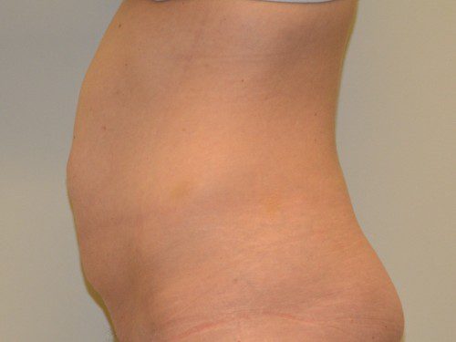 Tummy Tuck Before Patient 3