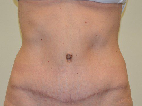 Tummy Tuck After Patient 1