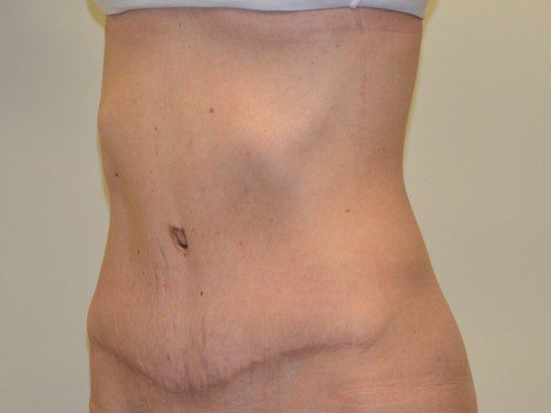 Tummy Tuck After Patient 2