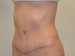 Tummy Tuck After Patient Thumbnail 2