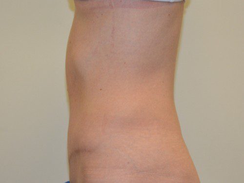 Tummy Tuck After Patient 3