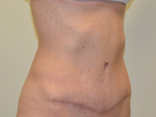 Tummy Tuck After Patient 4