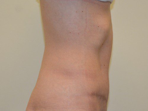 Tummy Tuck After Patient 5