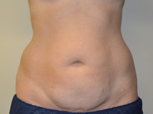 Tummy Tuck Before Patient 1