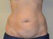 Tummy Tuck Before Patient Thumbnail 1