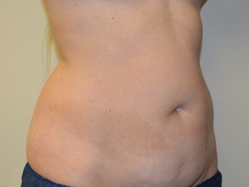 Tummy Tuck Before Patient 4