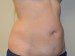 Tummy Tuck Before Patient Thumbnail 4